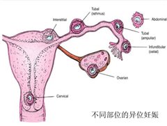 宮外孕6