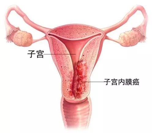 子宮內(nèi)膜癌圖片.webp